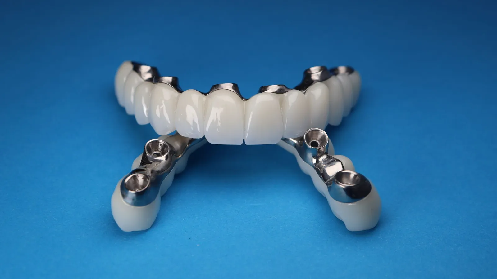 Bridge dentaire céramique monté sur une barre métallique usinée percée de puits d'implants